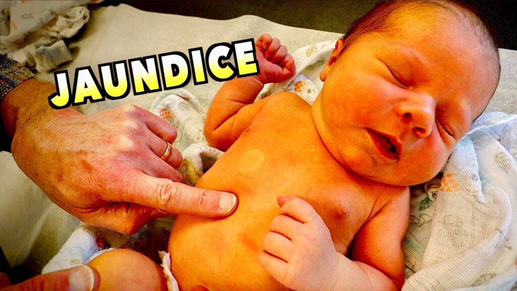 baby with jaundice