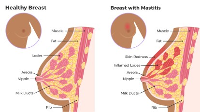 plugged ducts and mastitis