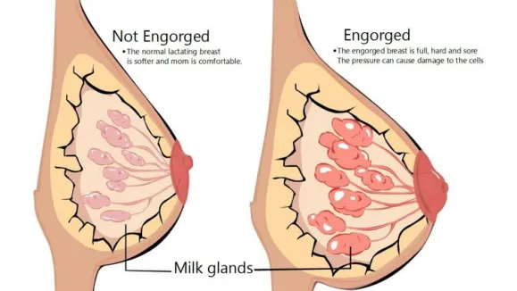 engorged breast